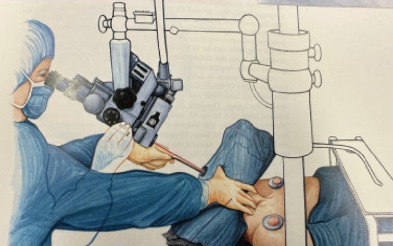 Transoral Laser Microsurgery Slider
