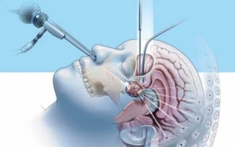 Base of Skull Surgeries slider