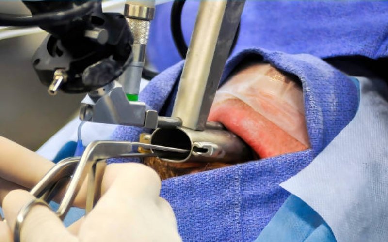 Endoscopic Laryngeal Surgery slider