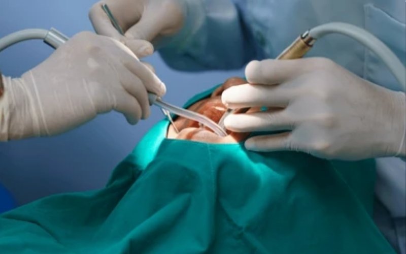 Minimally Invasive Commando Surgeries Slider