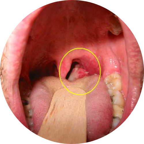 Tonsils tumors