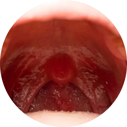 Throat cancer