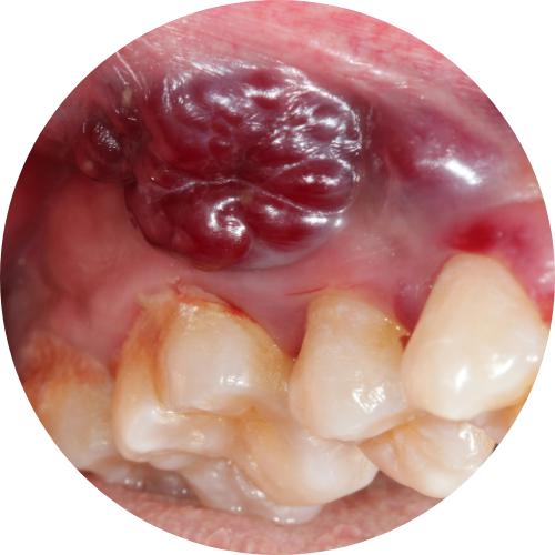 Suspicious Oral Growths​
