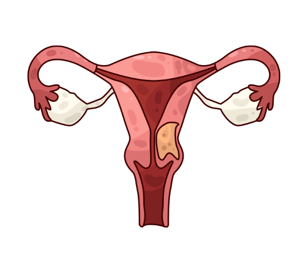 Ovary cancer