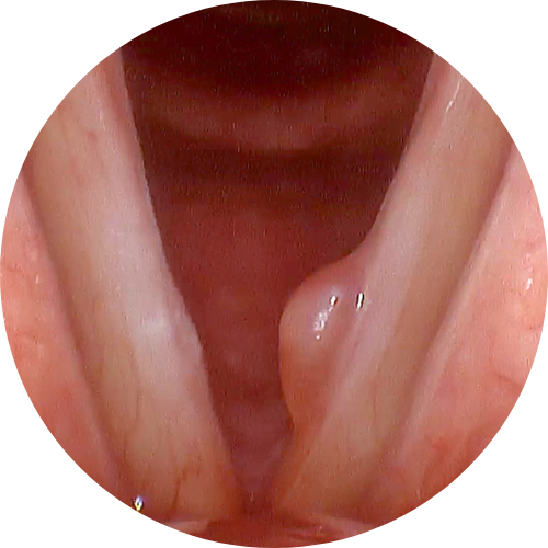 Vocal Cord Growths