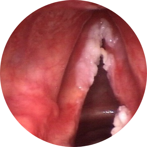 Pre-Cancerous Lesions