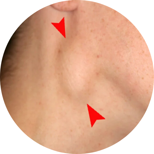 Neck Node
