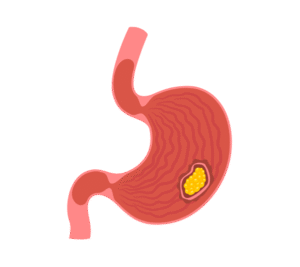 Stomach Ulcer